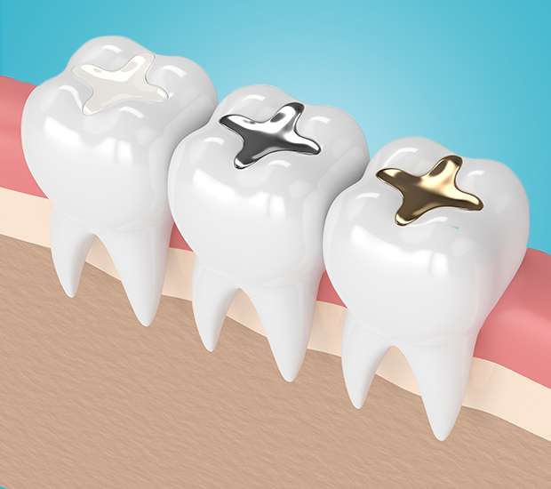Great Falls Composite Fillings