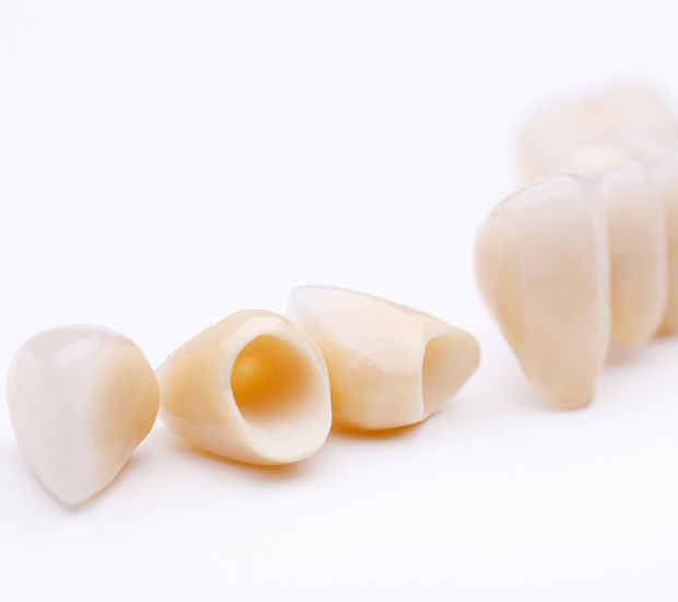 Great Falls Dental Crowns and Dental Bridges
