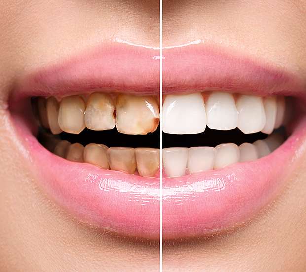 Great Falls Dental Implant Restoration