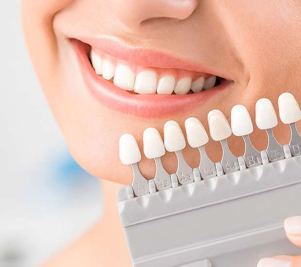 Great Falls Dental Veneers and Dental Laminates