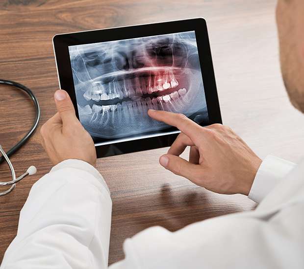 Great Falls Types of Dental Root Fractures