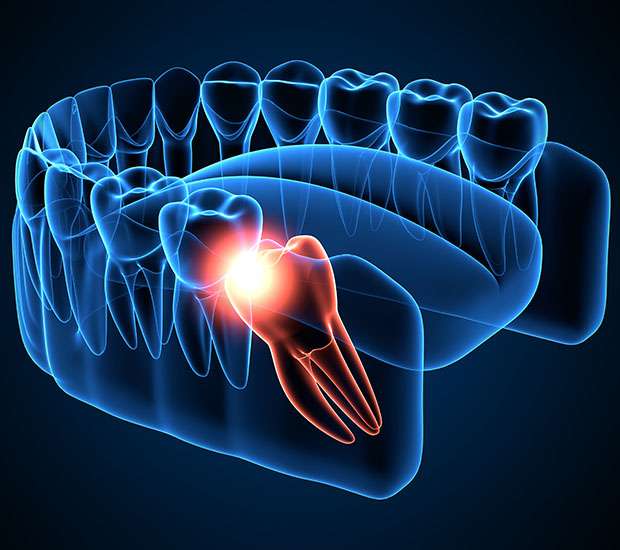 Great Falls Wisdom Teeth Extraction